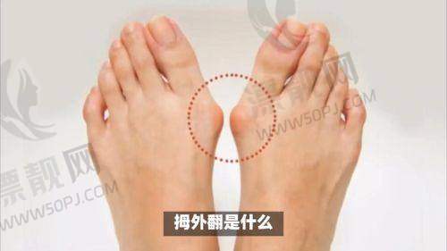 二、温建民拇外翻手术价格贵不贵？不藏着掖着的透明报价