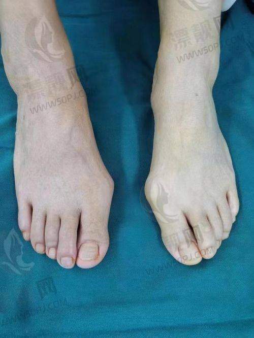 五、结语：做拇外翻找温建民，技术靠谱价格透明，真正“脚”得住！