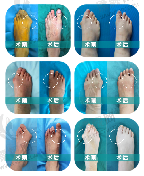 三、患者口碑到底咋样？咱们听听脚主们怎么说