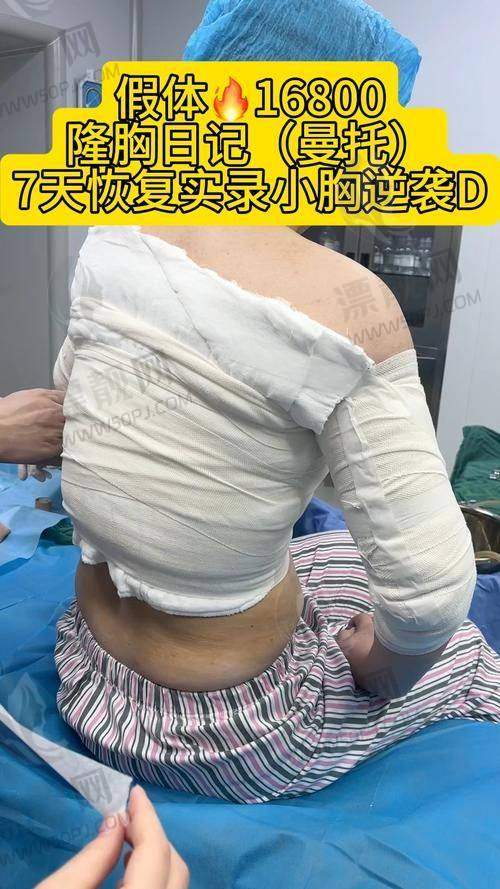 傲诺拉闪耀假体隆胸成效揭秘