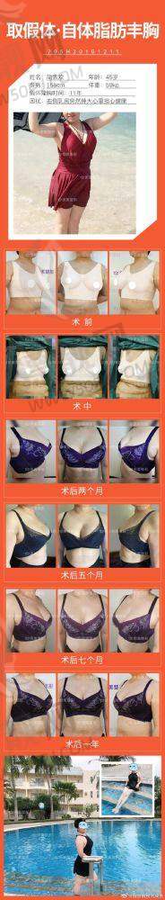 隆胸40天手感体验