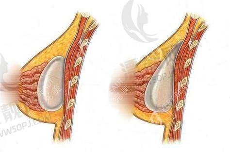 润致2号、3号与5号玻尿酸区别