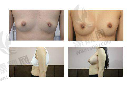 傲诺拉隆胸假体多少钱?各系列优势大揭秘,术后多久变软及用户论坛评价全知晓