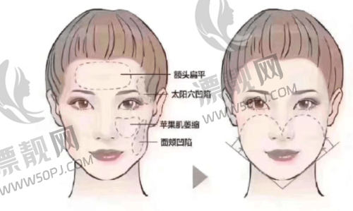 北京润美玉之光整形医院最擅长项目是什么?探索脂肪填充与吸脂价格