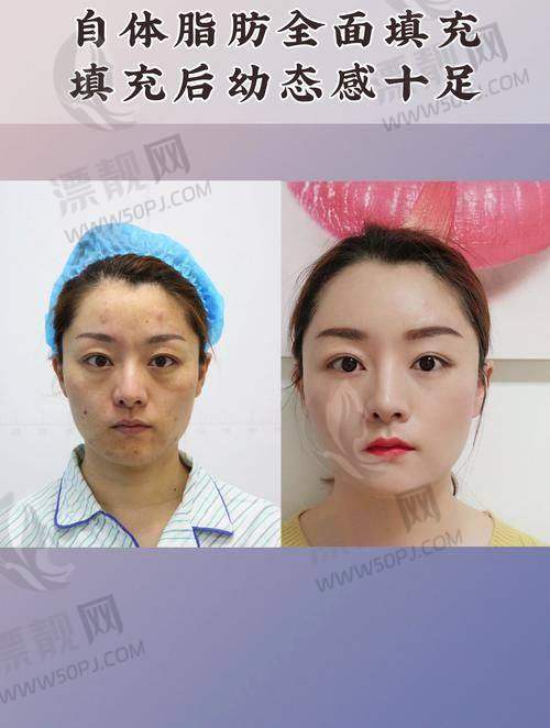 北京润美玉之光整形医院怎么预约挂号:脂肪填充价格13800元起,医院可靠预约便捷