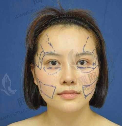 北京润美玉之光整形医院收费价格表详情:自体脂肪填充单部位低至30000元起